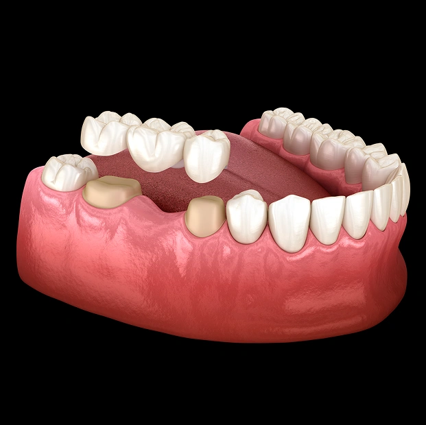 Dental Crowns & Bridges
