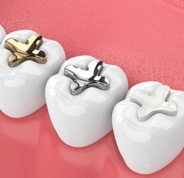 Tooth-Colored Fillings